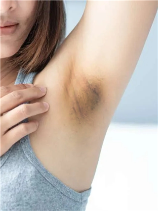 काखेतला काळसरपणा घालविण्यासाठी ५ टिप्स - Marathi News | काखेतला काळसरपणा घालविण्यासाठी ५ टिप्स | Latest Photos at Lokmat.com काखेतला काळसरपणा घालविण्यासाठी ५ टिप्स - Marathi News | काखेतला काळसरपणा घालविण्यासाठी ५ टिप्स | Latest Photos at Lokmat.com