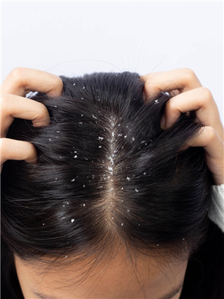 केसांतील कोंडा दूर करण्याचे ८ उपाय... - Marathi News | केसांतील कोंडा दूर करण्याचे ८ उपाय... | Latest Photos at Lokmat.com केसांतील कोंडा दूर करण्याचे ८ उपाय... - Marathi News | केसांतील कोंडा दूर करण्याचे ८ उपाय... | Latest Photos at Lokmat.com